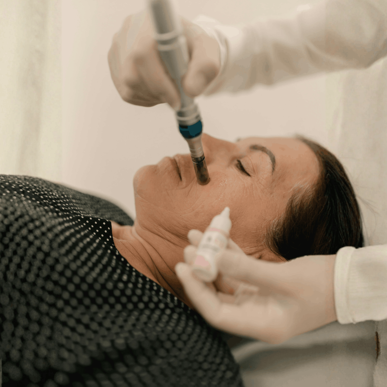 PRP & Microneedling - Image 2