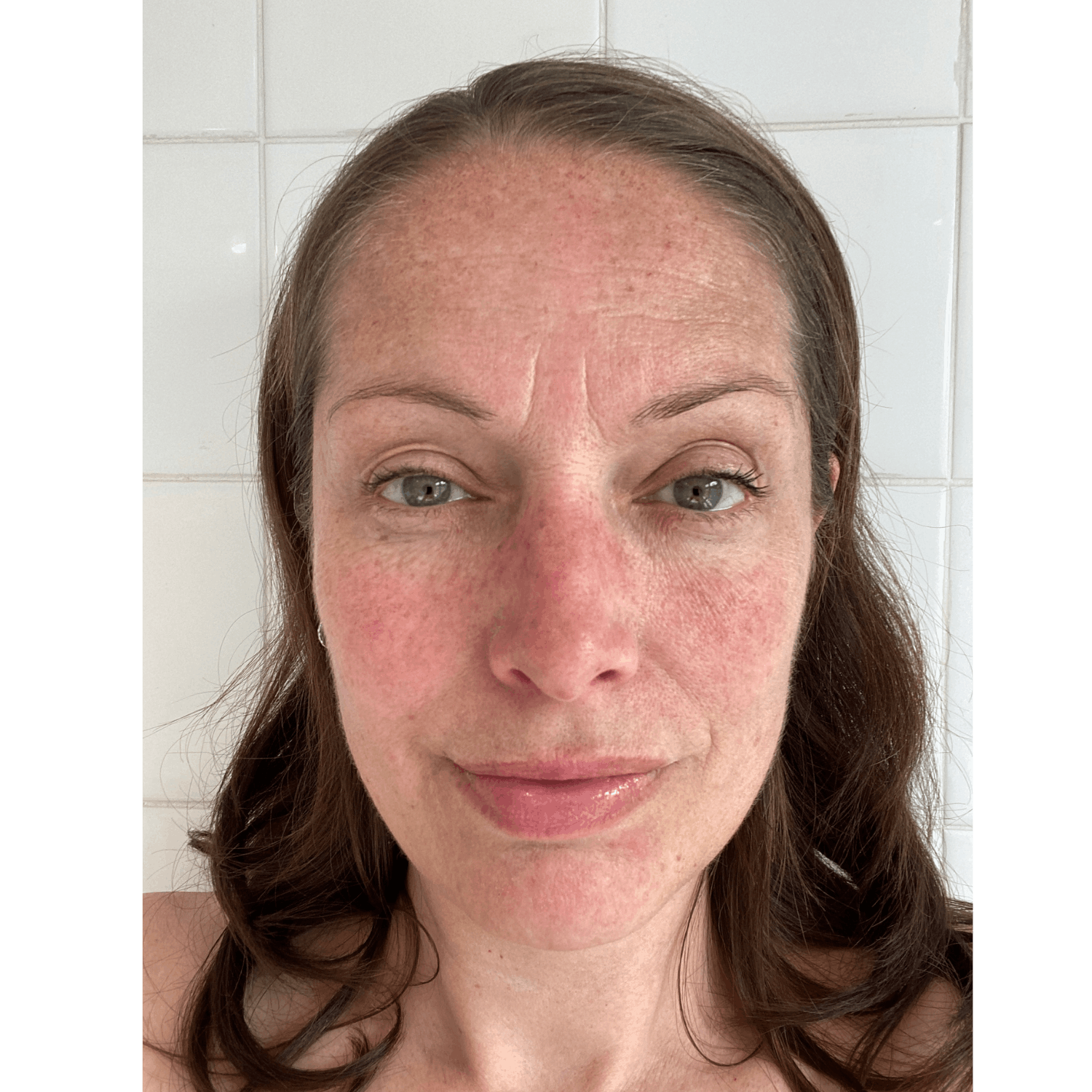 Melasma (Diagnosis and Treatment) - Image 2