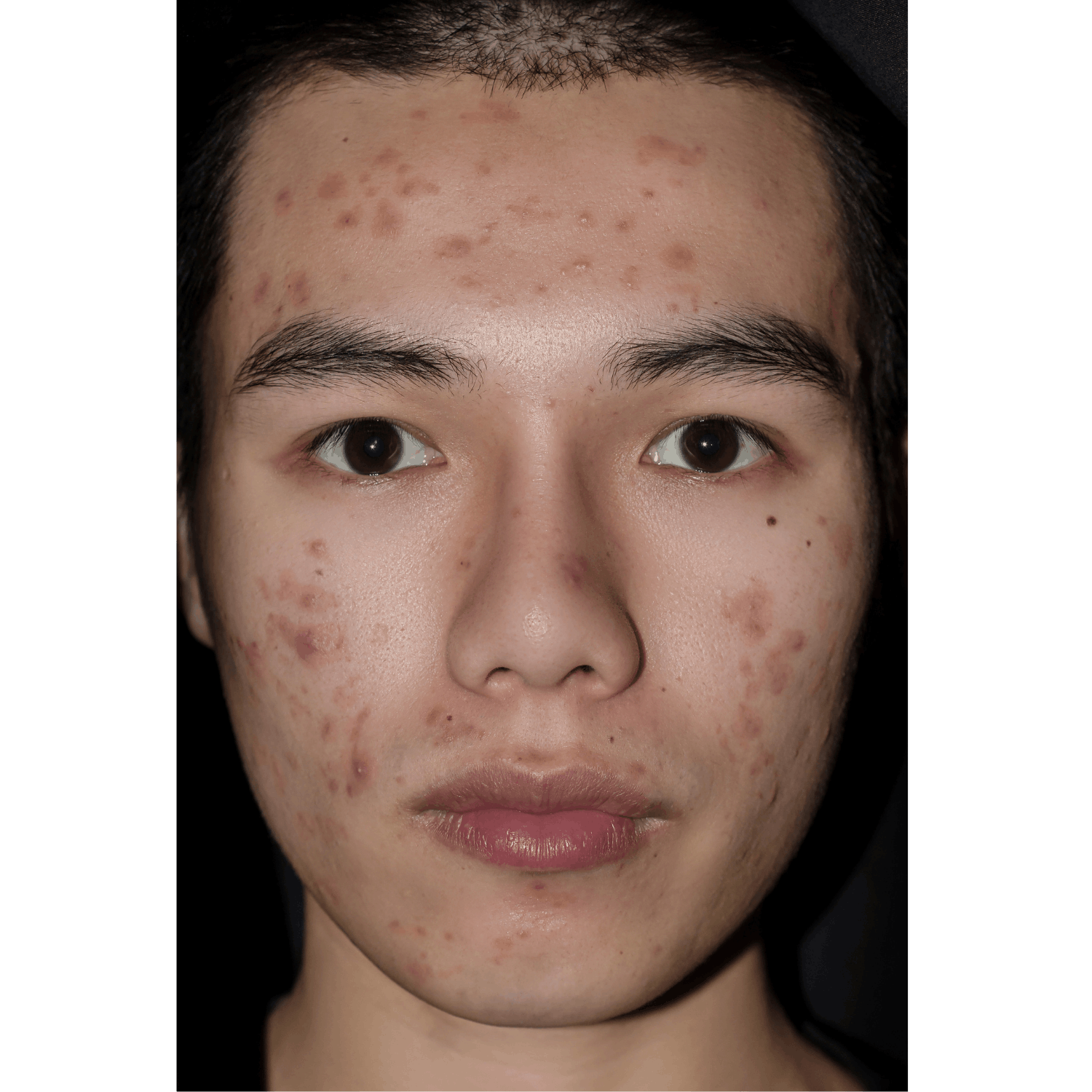 Acne Solutions (Advanced Protocols) - Image 2