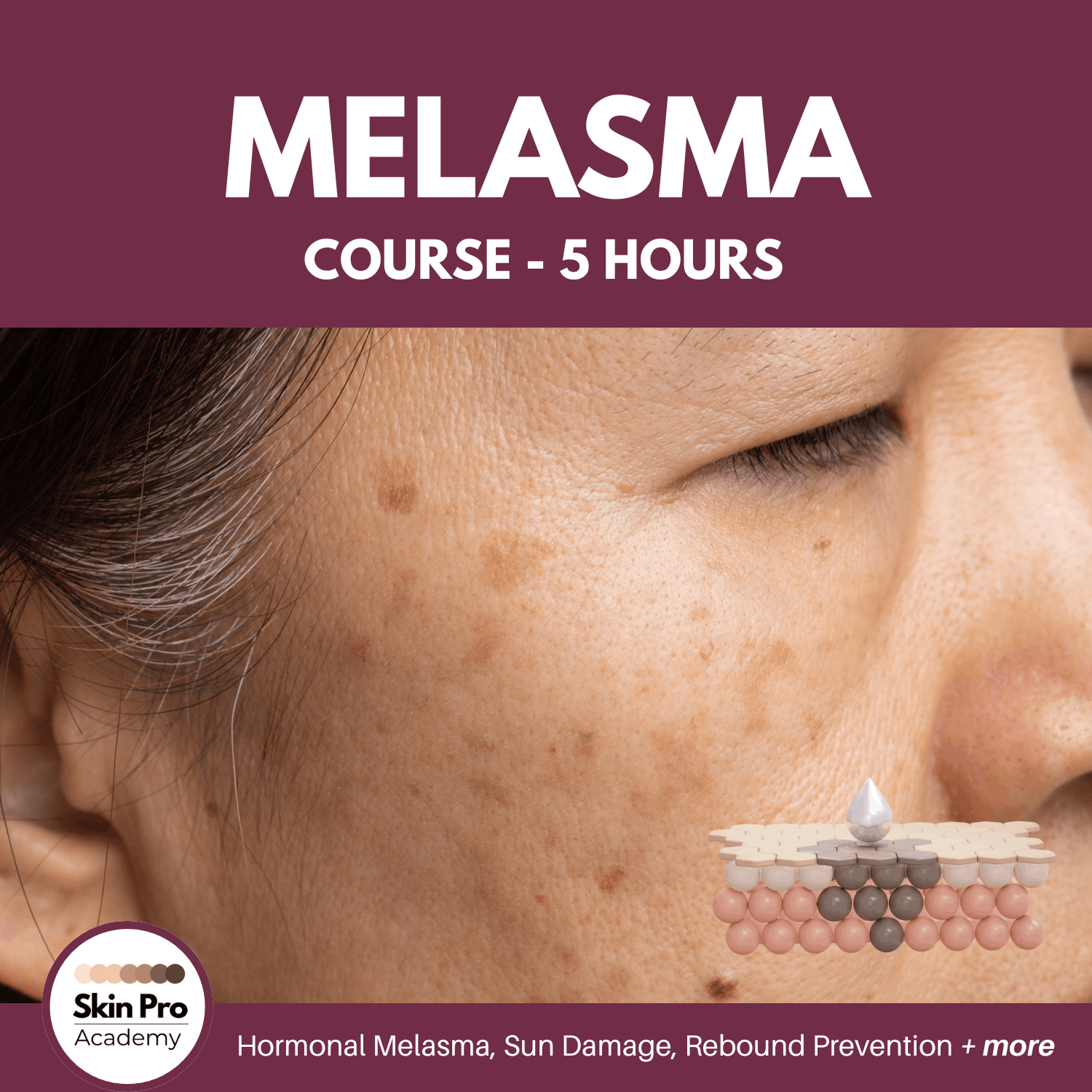 Melasma masterclass with SkinPro Academy