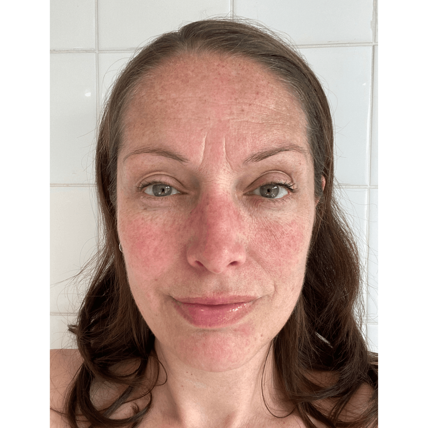 Become a Melasma patient SkinPro Academy