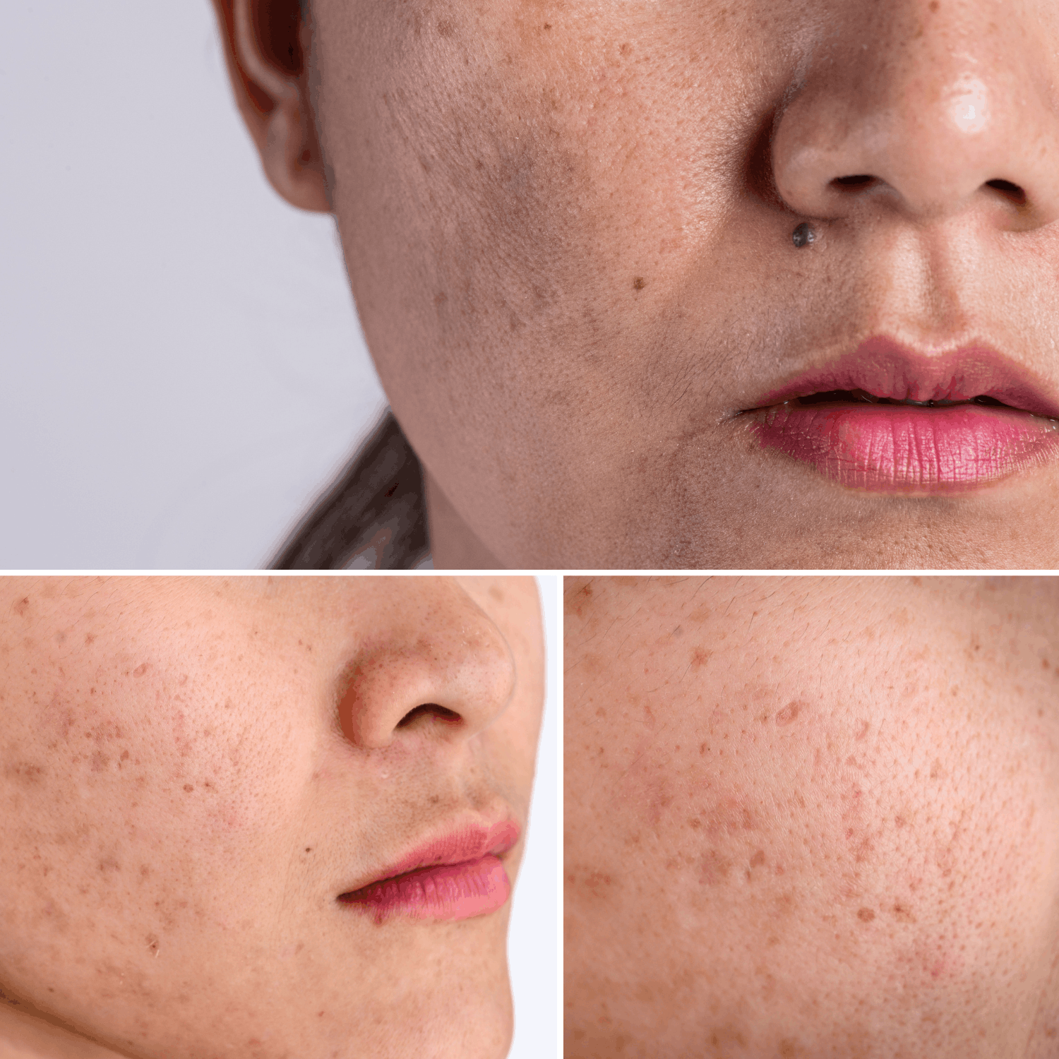 Master Melasma with SkinPro Academy
